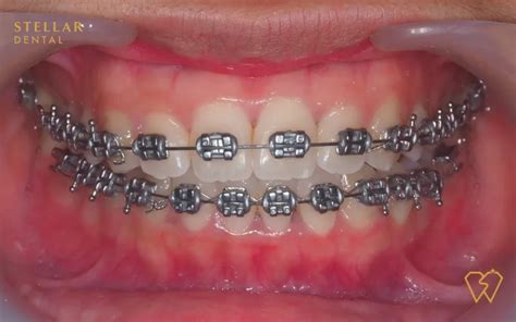 16 Braces Colors For Spring KadenClaye