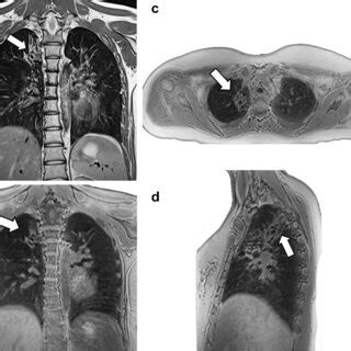 Magnetic Resonance Images In A 16 Year Old Girl With Bronchiectasis In