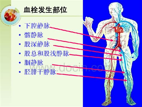 骨科大手术围手术期静脉血栓栓塞症的预防 好大夫在线