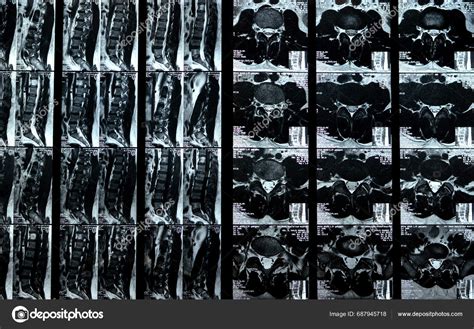 Cairo Egypt November Mri Lumbosacral Spine Revealed Straightening