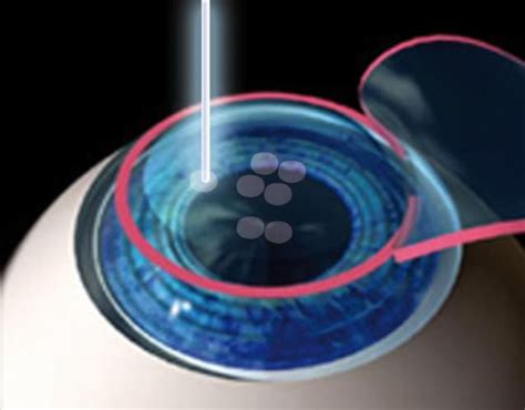 Everything You Need To Know About Excimer Laser Eye Operation