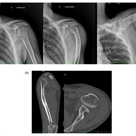 A Anteroposterior Preoperative Radiographs With Arm In Internal