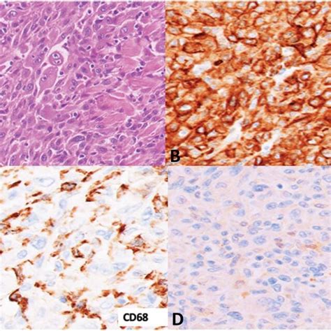 A Hematoxylin And Eosin Stain Depicting Pleomorphic Tumor Giant Cells