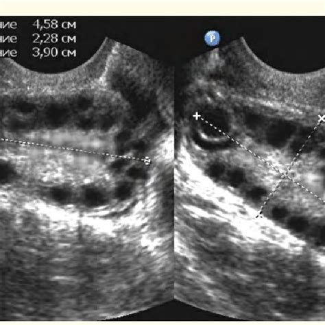 The main echographic type of PCOS. On the periphery of the ovary are ...