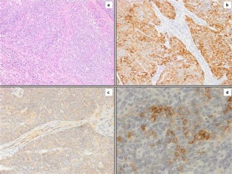 Oat Cells Pattern At Hematoxylin Eosin Staining Figure 2a Download Scientific Diagram