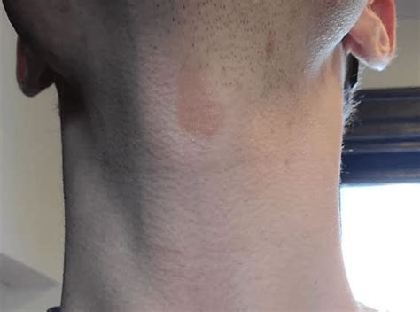 Circular rash on neck for TWO YEARS?? What is this? : r/eczema