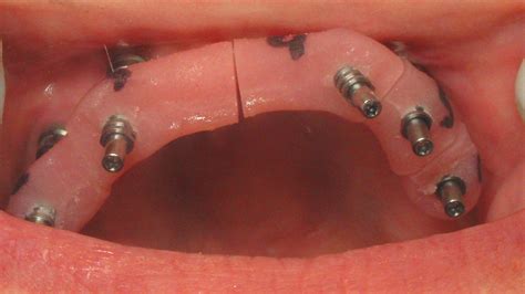 Restoring Full Arch Dental Implants With Bruxzir® Esthetic Glidewell