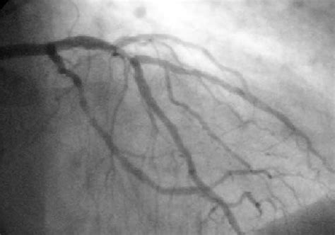 angiogram wikidoc