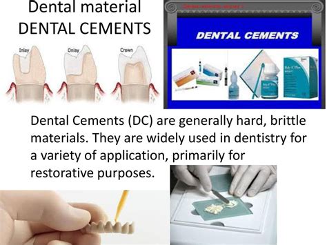 Ultimate Guide To The Types Of Dental Cements The Off