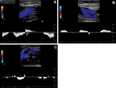 Varicose Veins Of The Lower Extremity Doppler Us Evaluation Protocols