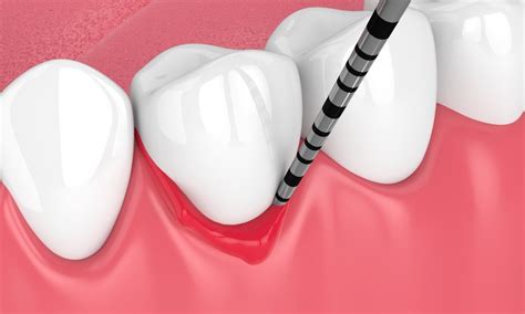 Managing Periodontal Disease With Dental Implants A Comprehensive Guide