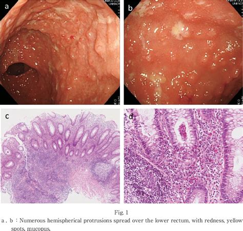 Figure From A Case Of Ulcerative Colitis Mimicking Chlamydia