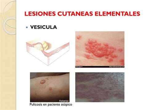 Lesiones Cutaneas Elementales Dermatologia Efrain Negrete PPT