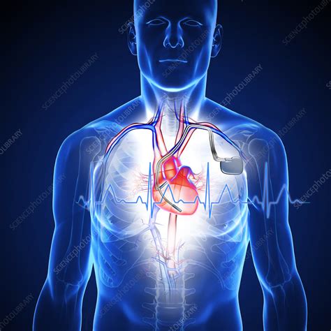 Pacemaker Illustration Stock Image C046 0176 Science Photo Library