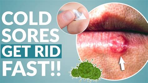 How To Get Rid Of Cold Sore Fast Youtube