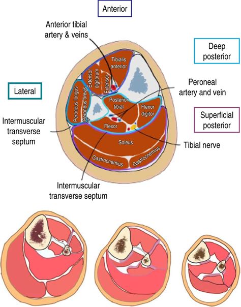 Compartment Syndrome In The Extremities