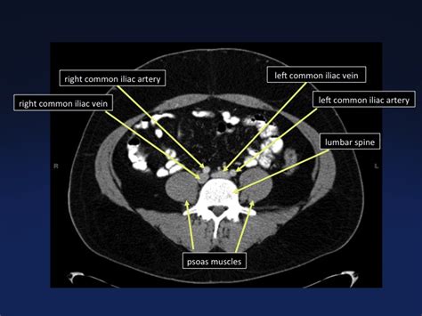 Cross Sectional Anatomy Of The Body Mdct Atlas Ct Scanning