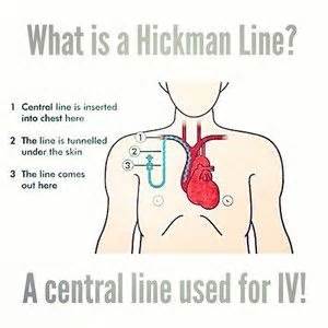 15 best Hickman Line images on Pinterest | Cancer, Cancer treatment and ...