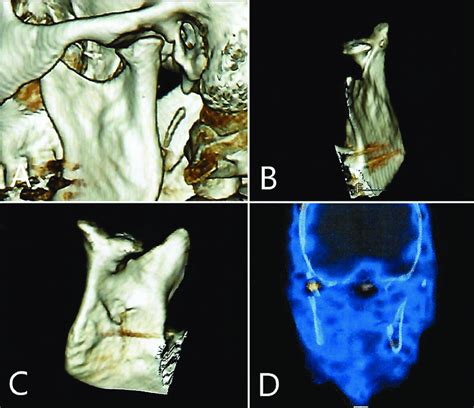 Case 2 Computed Tomography 3d Reconstruction A Sagittal View B Download Scientific Diagram