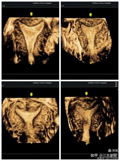 科普妇科超声检查利器经阴道三维彩超精准诊断妇科疾病 知乎