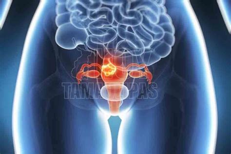 Hoy Tamaulipas Cancer De Endometrio El Mas Comun De Los Tumores Uterinos