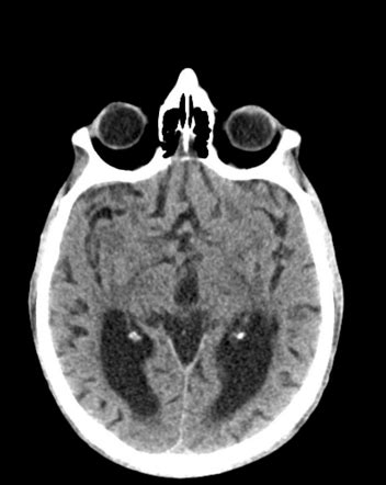 Normal Pressure Hydrocephalus Radiology Case Radiopaedia Org