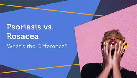 Psoriasis Vs Rosacea Whats The Difference Mypsoriasisteam