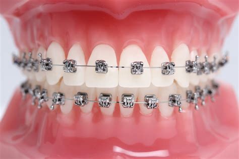 Metal Braces | Traditional Braces | Orthodontist | Wow Smiles