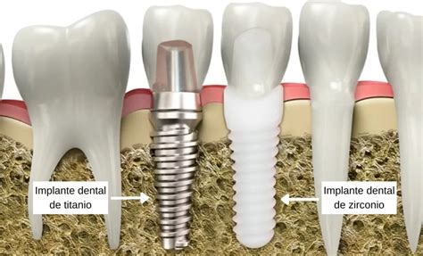 Cu L Es El Mejor Tipo De Implante Dental