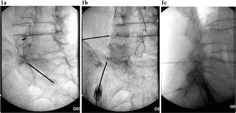 Figure From A Randomized Prospective Trial Of Cooled Versus