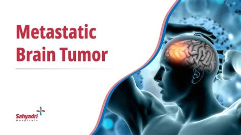 Brain Metastases Diagnosis And Treatment