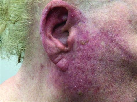 A Woman With Scaling And Painful Crusted Erythematous Papules And