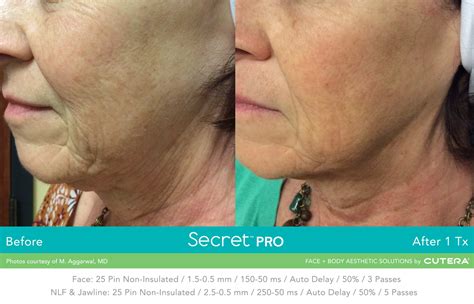 Secret Pro RF And Fractional CO2 Laser Image Perfect Laser