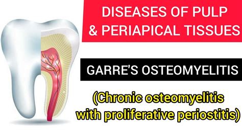 Garres Osteomyelitis Chronic Osteomyelitis With Proliferative