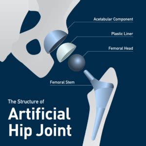 Stryker Hip Implant Lawyer | Simmons & Fletcher, P.C