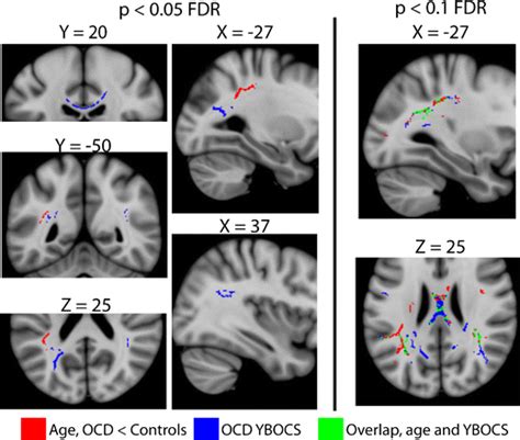 Positive Correlations Between YBOCS Compulsion Sub Scale And FA In OCD