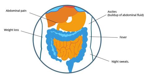 Mesothelioma Symptoms - Early Warning Signs of Abestos Cancer ...