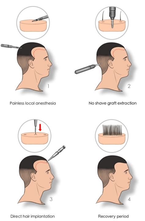 Unshaven Without Shaving Hair Transplant In Turkey Cost 2024