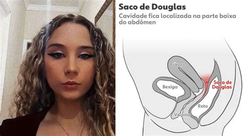 Saco De Douglas Entenda O Que A Regi O Citada No Atestado De Bito