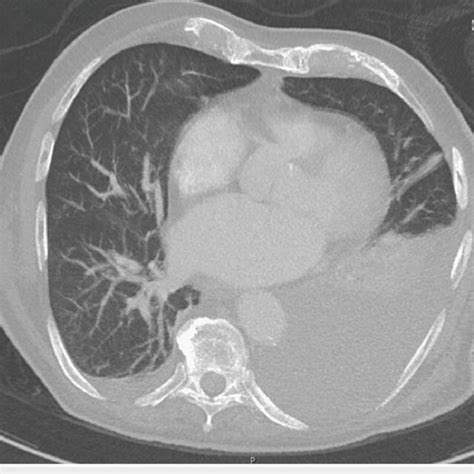 Ct Of The Chest Without Contrast Showing A Left Pleural Effusion Ct Download Scientific