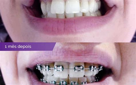 antes e depois insta Clínica Dentária Dentya Faz me sorrir