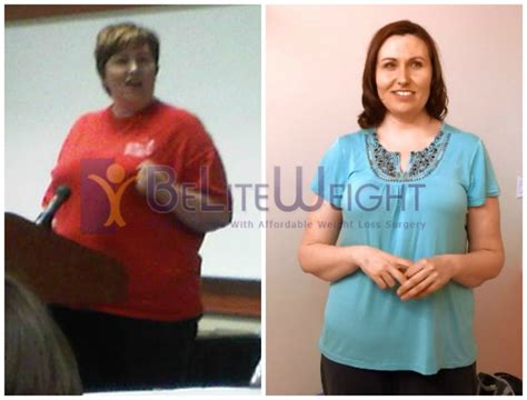 Kiely S 107 Pound Weight Loss After Gastric Sleeve Surgery Beliteweight Weight Loss Services