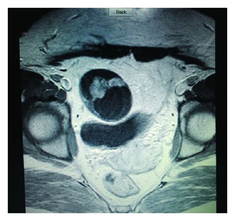 Pelvic Mri The Right Adnexal Mass Download Scientific Diagram