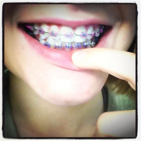 Pink And Purple Braces Pink Braces Braces Colors Teeth Braces