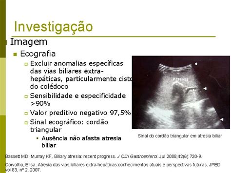 Atresia De Vias Biliares Extrahepticas Residente Larissa Caetano