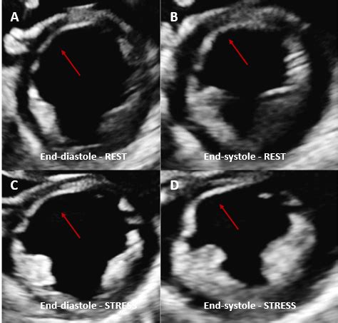 Dobutamine stress echo performed in a patient with coronary artery ...