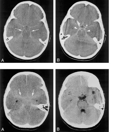 Figure 2 From Pseudo Subarachnoid Hemorrhage A Potential Imaging Pitfall Associated With