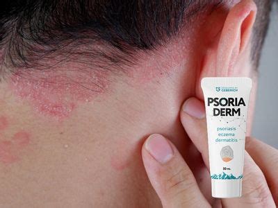 Psoriaderm crema Para qué sirve precio opiniones dónde la venden