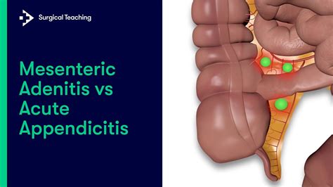 Mesenteric Adenitis Vs Appendicitis How To Tell The Difference Youtube