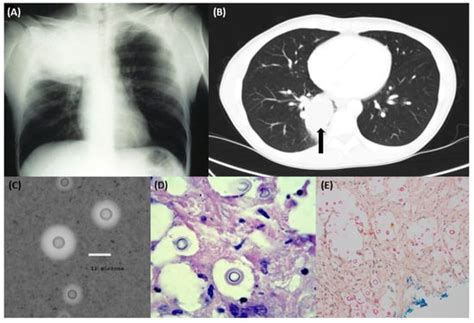 Jof Free Full Text Pulmonary Cryptococcosis